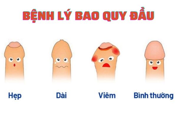 Bệnh lý về bao quy đầu khá phổ biến