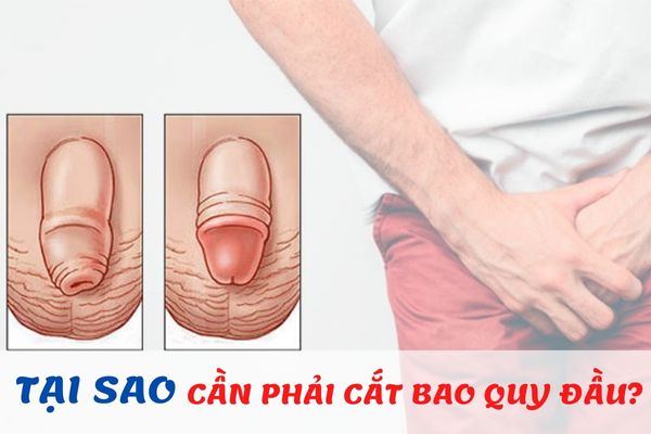 Tại sao cần phải cắt bao quy đầu? - Những lưu ý quan trọng dành cho nam giới