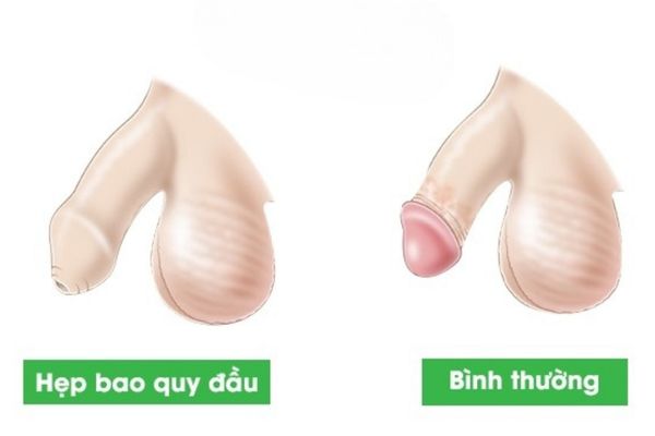 Hẹp bao quy đầu là bệnh lý phổ biến ở nam giới