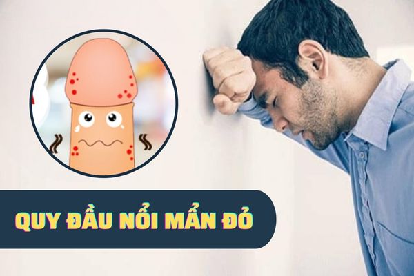 Quy đầu nổi mẩn đỏ cảnh báo bệnh lý gì – Cách điều trị hiệu quả nhất