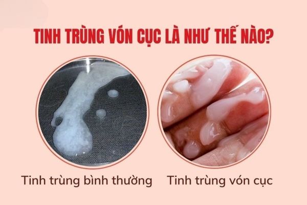 tinh-trung-von-cuc