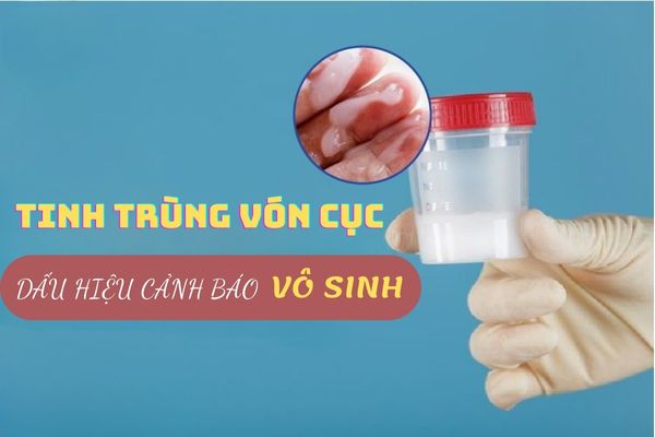 Tinh trùng vón cục – Nguy cơ cảnh báo vô sinh đáng báo động