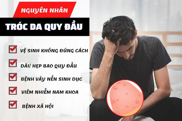 Tróc da quy đầu do nhiều nguyên nhân khác nhau gây ra