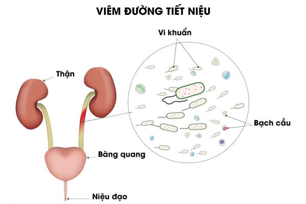 Viêm đường tiết niệu là bệnh lý phổ biến ở nam giới