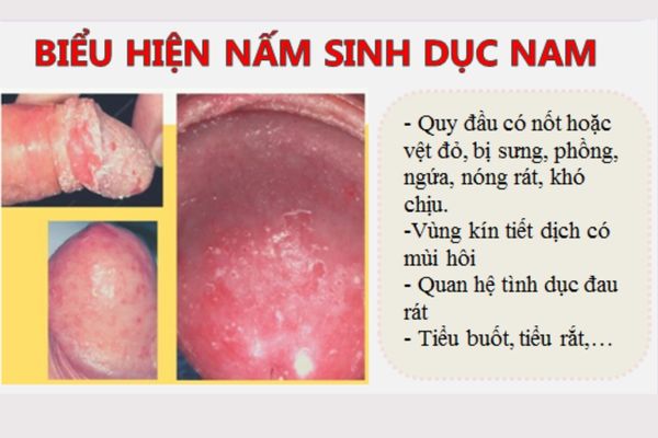 Triệu chứng nhận biết bệnh nấm vùng kín ở nam giới