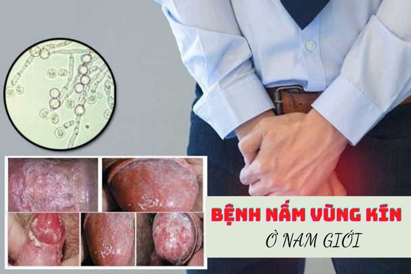 Bệnh nấm vùng kín ở nam giới là gì? Cách điều trị dứt điểm