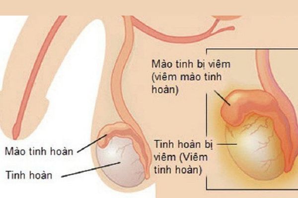 Bệnh viêm tinh hoàn, viêm mào tinh hoàn phổ biến ở nam giới