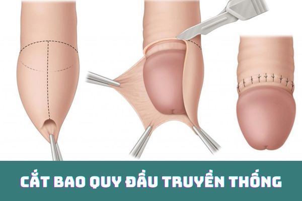 Phương pháp cắt bao quy đầu truyền thống