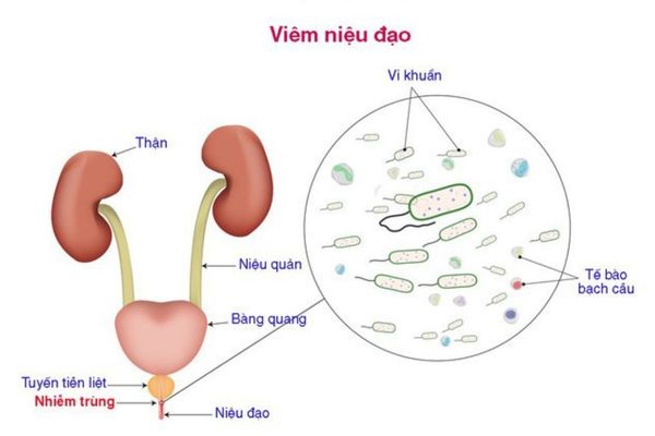 Viêm niệu đạo là bệnh lý gây ra tình trạng tiểu buốt