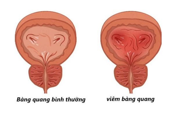 Viêm bàng quang là tình trạng thường gặp ở các cánh mày râu