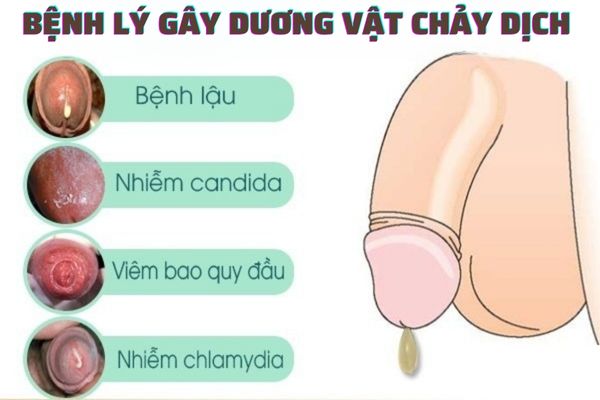 Dương vật chảy dịch cảnh báo nhiều bệnh lý nguy hiểm khác nhau