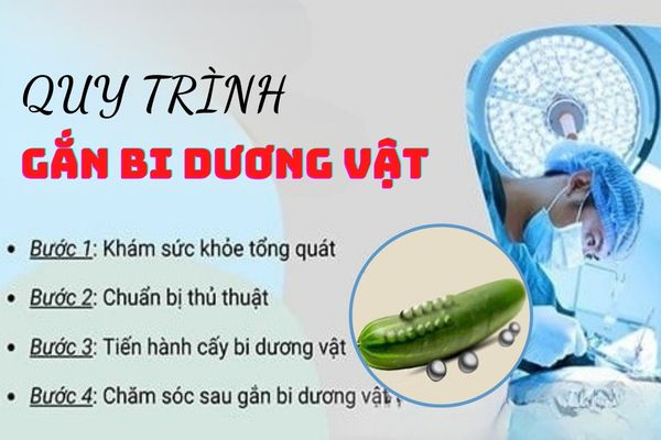 Quy trình thực hiện gắn bi dương vật tiêu chuẩn