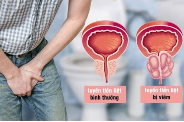 Tuyến tiền liệt bị viêm gây ra hiện tượng tiểu buốt, tiểu rát