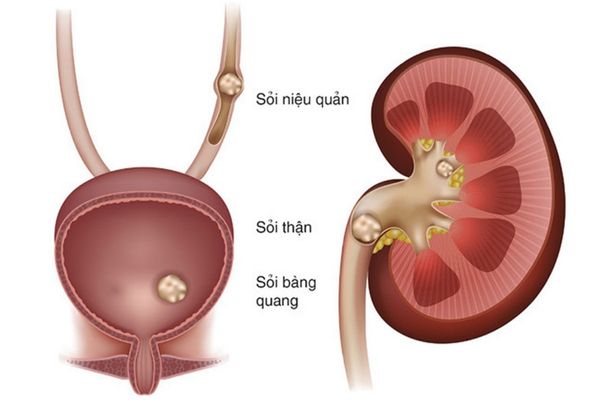 Sỏi đường tiết niệu gây ra hiện tượng tiểu buốt ở nam giới