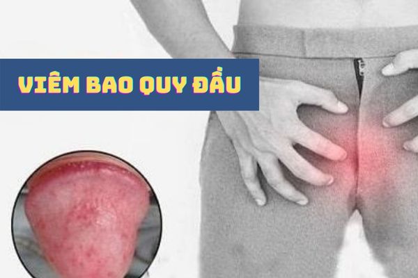 Viêm bao quy đầu khiến dương vật nam giới ngứa rát, khó chịu