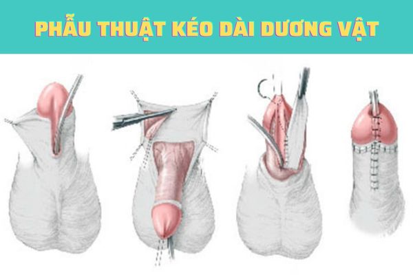 Phẫu thuật kéo dài kích thước dương vật 