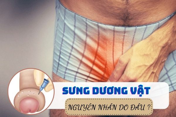 Tại sao sưng dương vật ở nam giới? Cách điều trị hiệu quả