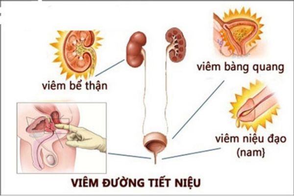 Nhiễm trùng đường tiết niệu gây ảnh hưởng đến hệ bài tiết