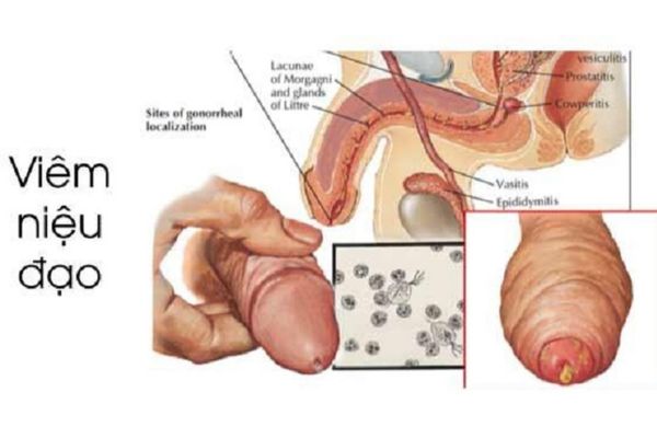 Viêm niệu đạo là bệnh lý phổ biến ở nam giới