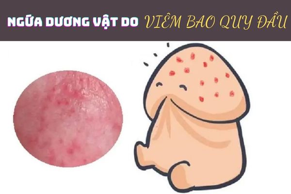 Viêm bao quy đầu là nguyên nhân hàng đầu gây ngứa dương vật