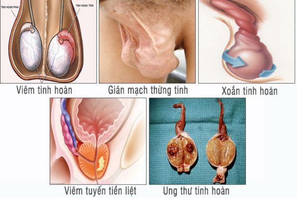 Đau bìu cảnh báo nhiều bệnh lý nguy hiểm ở nam giới