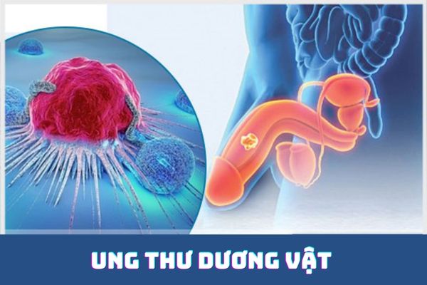 Nổi hạch dương vật cảnh báo bệnh lý ung thư nguy hiểm