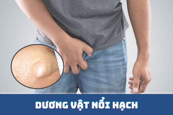 Dương vật nổi hạch – Triệu chứng bệnh lý không nên xem thường