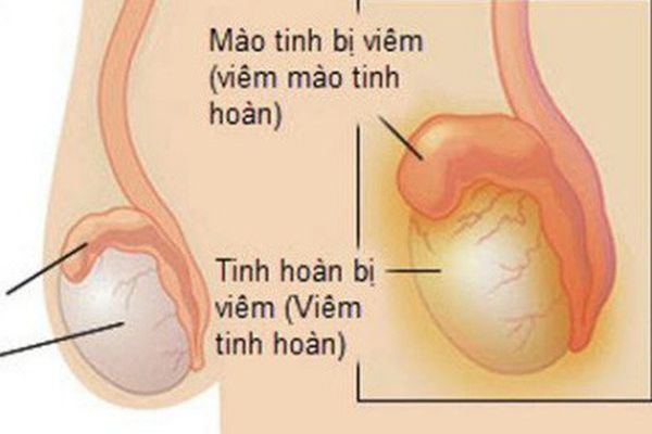 Viêm tinh hoàn là bệnh lý phổ biến ở nam giới