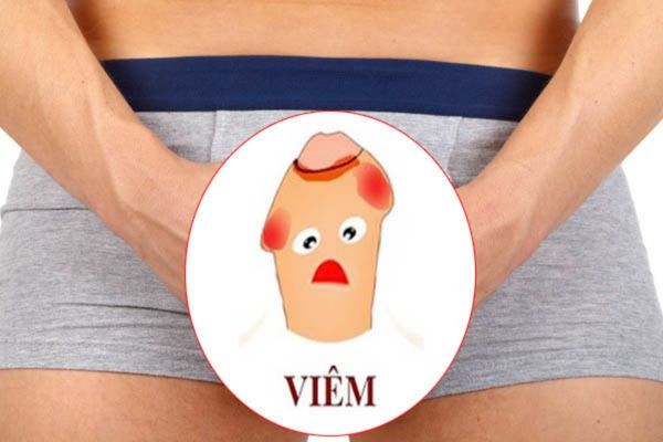 Viêm bao quy đầu là bệnh lý gây ngứa cậu nhỏ phổ biến