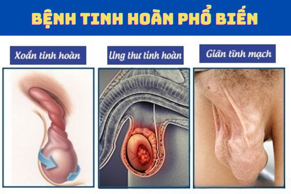 Ngứa tinh hoàn là triệu chứng nhận biết nhiều bệnh lý tinh hoàn ở nam giới