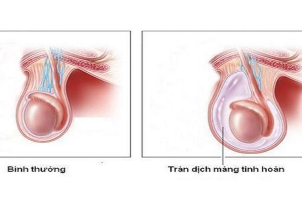 Sưng tinh hoàn là dấu hiệu cảnh báo bệnh tràn dịch màng tinh hoàn