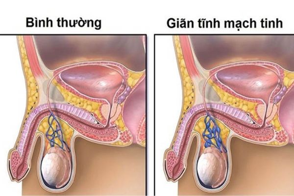 Giãn tĩnh mạch thừng tinh gây ra triệu chứng đau sưng tinh hoàn