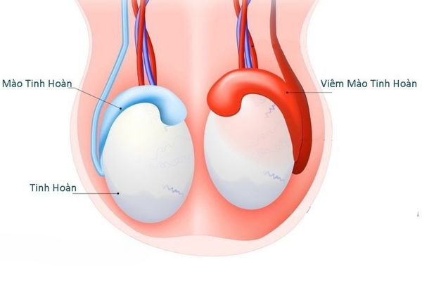 Suy tinh hoàn do viêm mào tinh hoàn gây ra