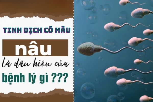 Tinh dịch có màu nâu cảnh báo bệnh gì ở nam giới?