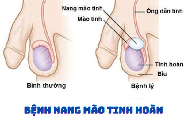 Tinh hoàn nổi hạch do bệnh nang mào tinh hoàn