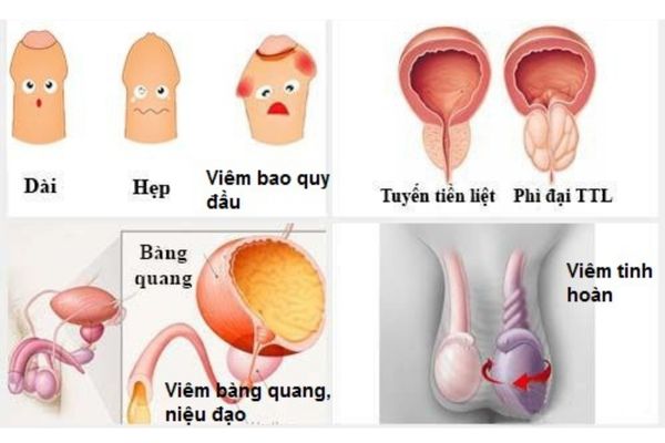 Các bệnh lý nam giới thường gặp nhất