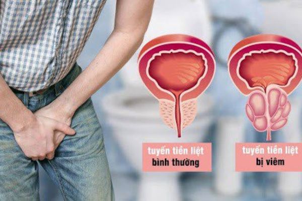 Đau khi xuất tinh do bệnh viêm tuyến tiền liệt