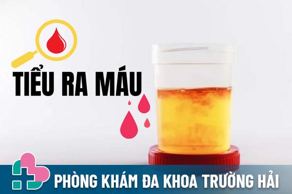 Tiểu ra máu “báo động” nguy hiểm