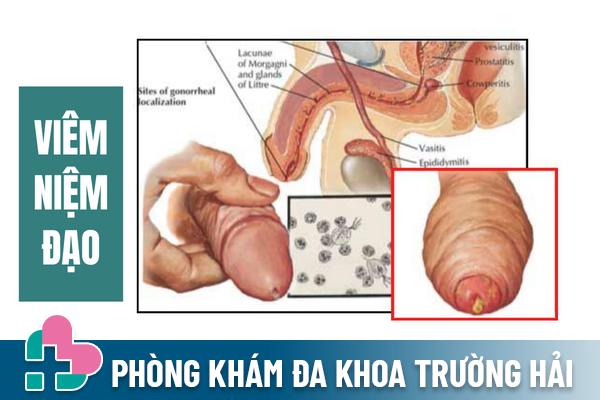 Dung-xem-nhe-viem-nieu-dao-o-nam-1