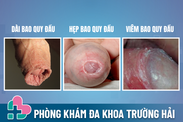 Hieu-dung-ve-dinh-bao-quy-dau-de-tri-dung-cach-1