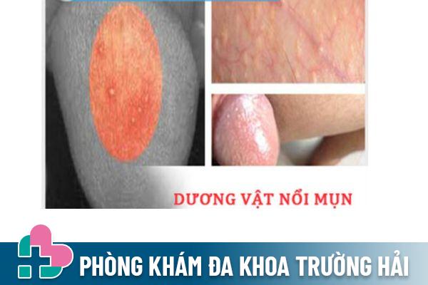 Dương vật nổi mụn là dấu hiệu của bệnh lý gì?