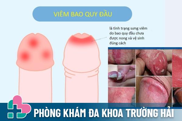 Dấu hiệu viêm bao quy đầu và cách điều trị