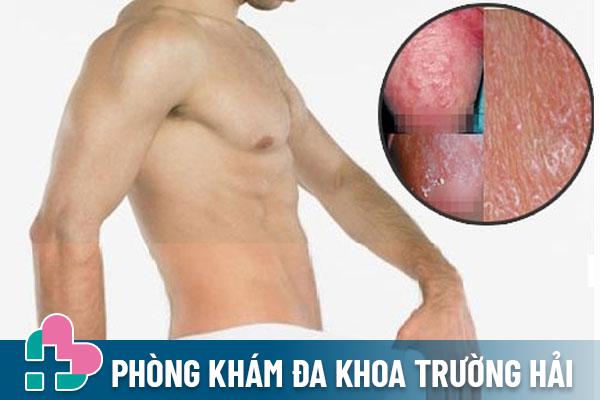 Nứt bao quy đầu: Nguyên nhân, Triệu chứng và Cách chữa hiệu quả