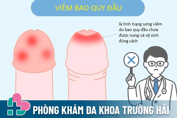 Viêm bao quy đầu: Dấu hiệu, Hình ảnh và Cách điều trị hiệu quả